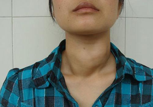 甲状腺结节是什么原因引起的 看完这些一定得