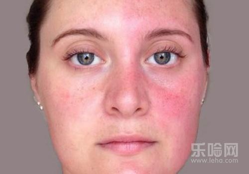 用热水洗脸后皮肤毛孔处发红是,用热水洗脸后