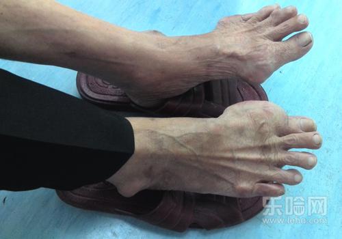 尿酸高多少会引起痛风,尿酸高多少算痛风,尿酸