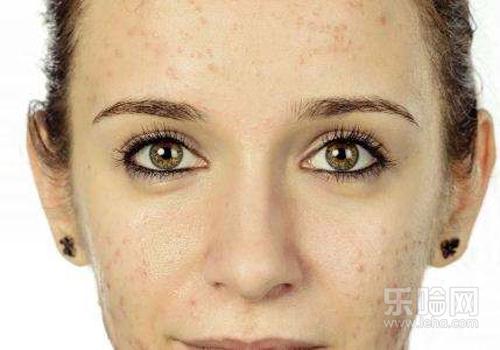 脸上长了很多小颗粒挤出是白色,脸上长了很多