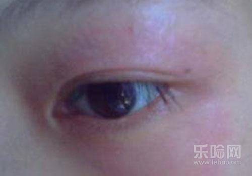 眼睛过敏痒怎么办,眼睛过敏该怎么办-乐哈健康