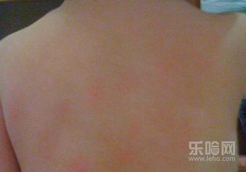 宝宝身上起红点点是怎么回事,宝宝身上有红点
