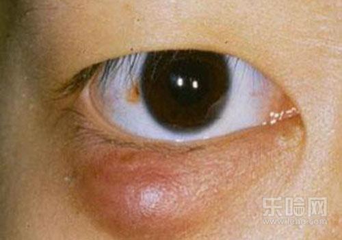 眼睛起针眼怎么办,眼睛长针眼怎么办,长针眼了