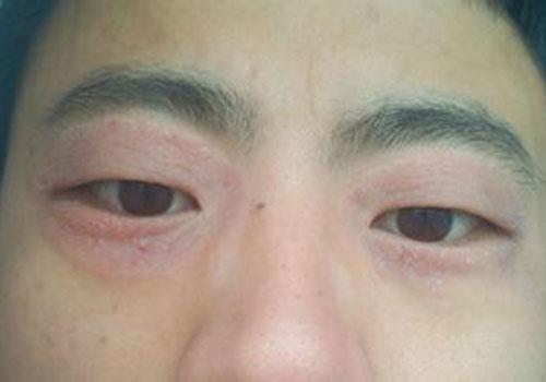 眼睛周围红肿痒起皮怎么回事,眼睛起皮红肿怎