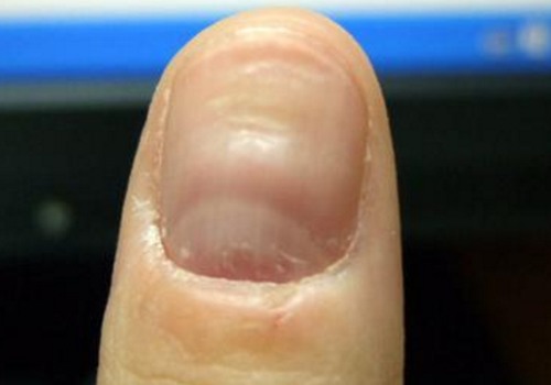 指甲上有横纹凹陷是怎么回事 指甲上有横纹凹