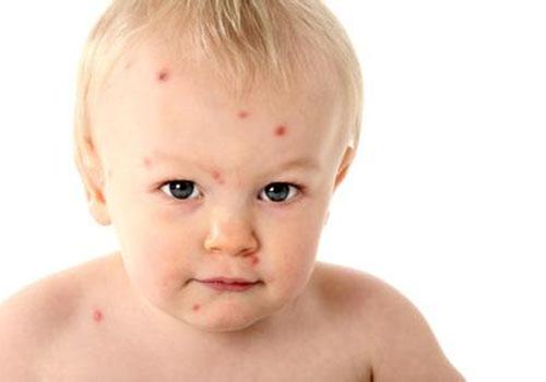 宝宝蛋白质过敏怎么办,宝宝蛋白质过敏吃什么