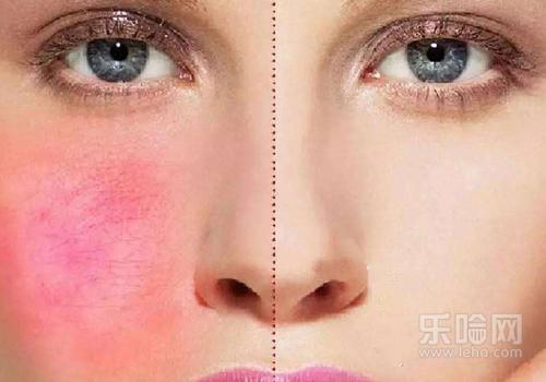 脸颊有红血丝怎么办,脸颊红血丝怎么回事-乐哈