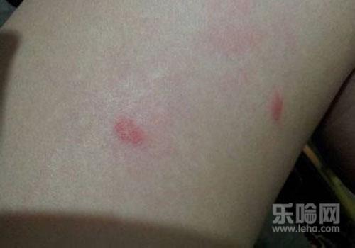 春天身上痒是怎么回事,春天身上起红疙瘩很痒