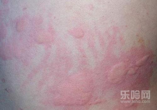 春天身上痒是怎么回事,春天身上起红疙瘩很痒