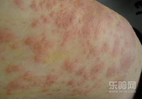 春天身上痒是怎么回事,春天身上起红疙瘩很痒