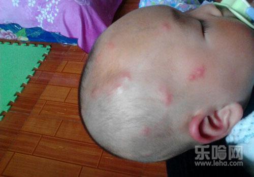 宝宝长水痘可以洗澡吗,宝宝有水痘可以洗澡吗