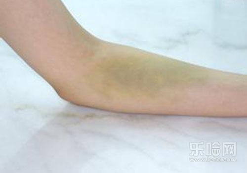 抽血胳膊淤青了怎么办,胳膊抽血后淤青怎么办