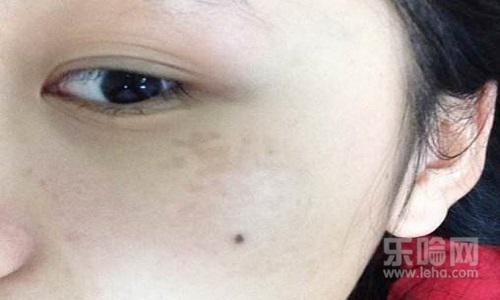 激光祛斑几天结痂脱落,激光祛斑结痂几天能掉