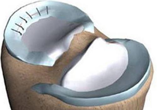 半月板缝合术后多久才能走路,半月板缝合多久