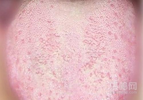 舌苔头发白是艾滋病吗,舌头发白是不是艾滋病