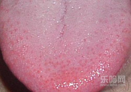 舌苔头发白是艾滋病吗,舌头发白是不是艾滋病