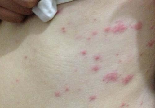 得了湿疹能吃什么水果 得了湿疹不能吃什么水果