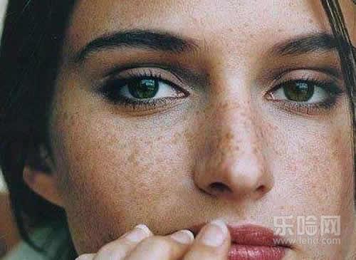 蝴蝶斑激光能去掉吗,激光能去蝴蝶斑吗-乐哈健