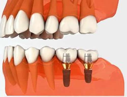 牙龈萎缩出血是什么原因,牙龈萎缩出血是怎么