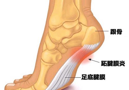 脚后跟底部疼是什么原因,脚底后跟痛是什么原