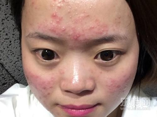 青春痘一般长到几岁,青春痘几岁消失-乐哈健康