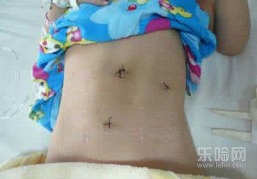 畸胎瘤腹腔镜手术后多久可以上班,畸胎瘤腹腔