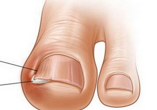 甲沟炎最佳治疗方法,不用拔甲,1招让你在家就