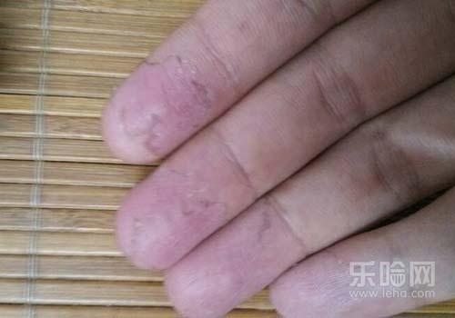 手指脱皮开裂痒是怎么回事