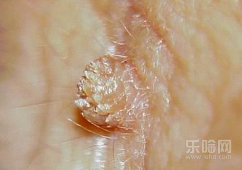 瘊子祛除激光还是冷冻,瘊子激光和冷冻哪个好