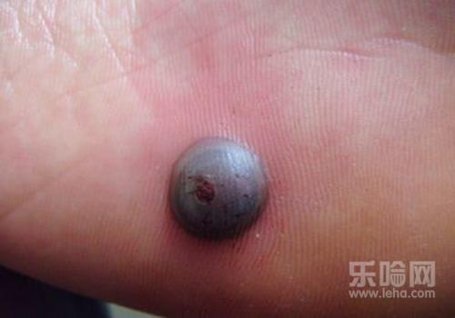 瘊子冷冻后的水泡能弄破么,瘊子液氮冷冻后起