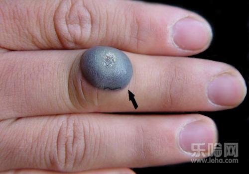 瘊子冷冻后的水泡能弄破么,瘊子液氮冷冻后起