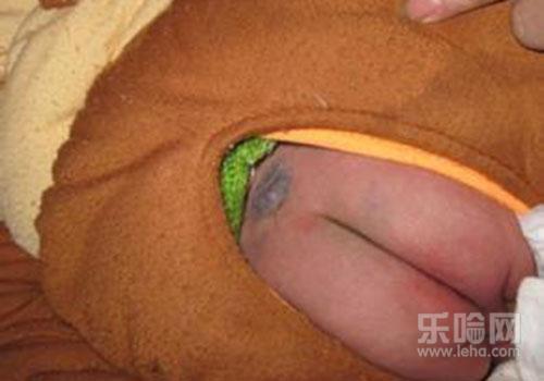 脊柱裂能治好吗?小孩尾椎骨异常就是脊柱裂吗