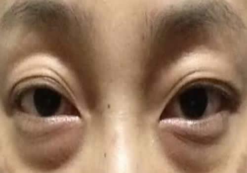 熬夜眼袋多久可以恢复