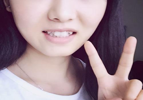 矫正虎牙会改变脸型吗,矫正虎牙能改变脸型吗