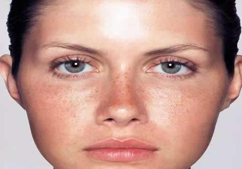 激光祛斑后反黑怎么办,激光祛斑反黑后会恢复