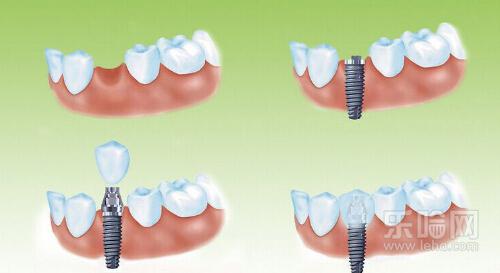 种植牙疼不疼,种植牙会痛吗-乐哈健康网