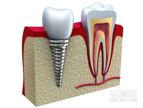种植牙疼不疼,种植牙会痛吗-乐哈健康网