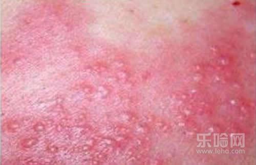 寨卡病毒是什么症状,寨卡病毒的临床表现有哪