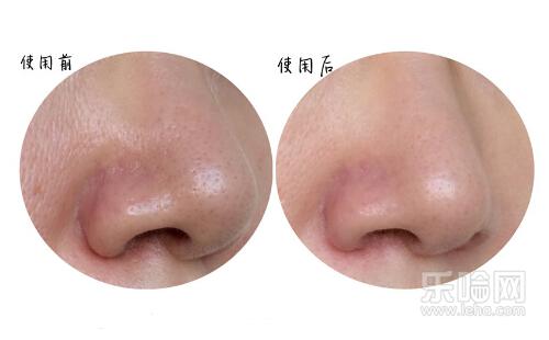 激光缩毛孔价格,激光缩毛孔多少钱-乐哈健康网