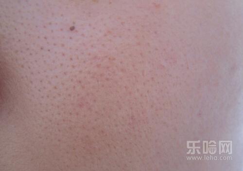 激光缩毛孔多久恢复,激光收缩毛孔恢复时间-乐