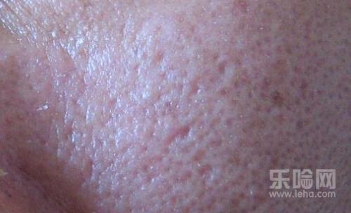 激光缩毛孔是永久的吗,激光缩毛孔能保持多久