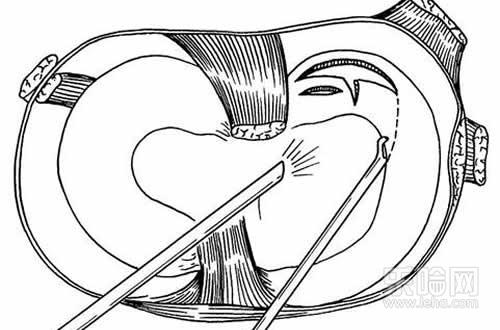 半月板损伤能自愈吗,膝关节半月板损伤能自愈