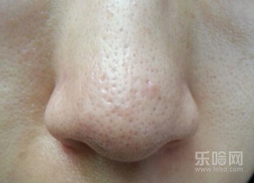 激光缩毛孔多久恢复,激光收缩毛孔恢复时间-乐