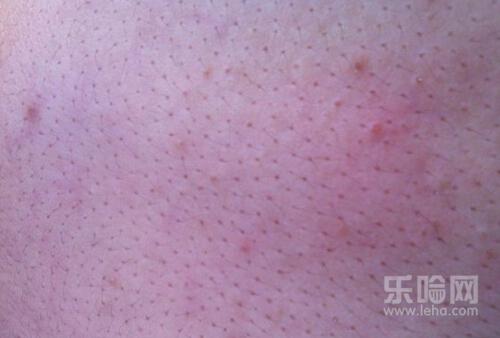 激光缩毛孔价格,激光缩毛孔多少钱-乐哈健康网