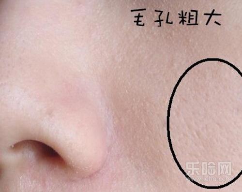 激光缩毛孔多久恢复,激光收缩毛孔恢复时间-乐