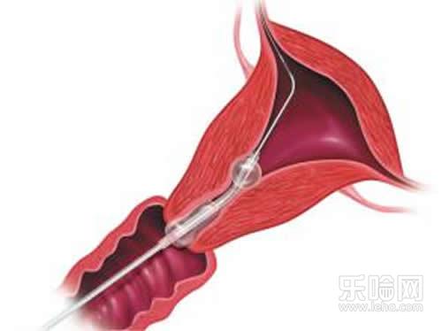 输卵管造影要多久时间,输卵管造影多长时间做