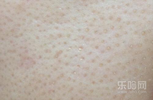 激光缩毛孔是永久的吗,激光缩毛孔能保持多久