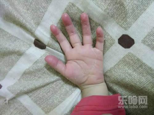 小孩手指脱皮是怎么回事,小孩手指头脱皮是什