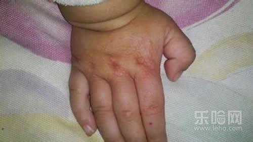 小孩手指脱皮是怎么回事,小孩手指头脱皮是什