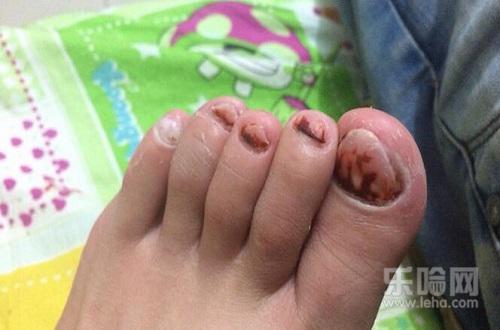 灰指甲擦什么药好,什么药治灰指甲最好,治灰指